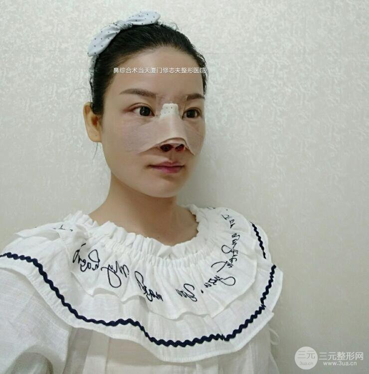 廈門修志夫隆鼻整形前后對比圖真人案例恢復(fù)小札