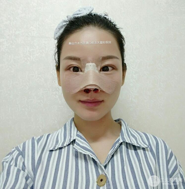 廈門修志夫隆鼻整形前后對比圖真人案例恢復(fù)小札