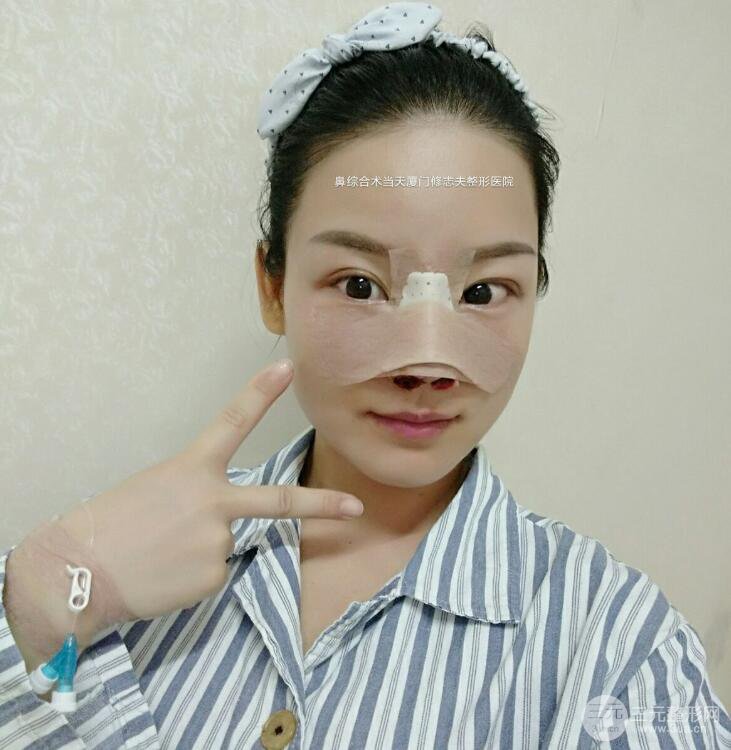 廈門修志夫隆鼻整形前后對比圖真人案例恢復(fù)小札