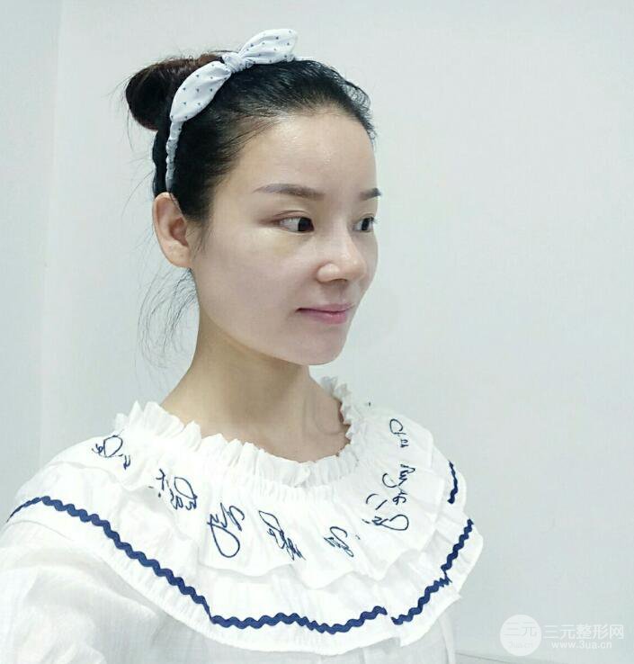 廈門修志夫隆鼻整形前后對比圖真人案例恢復(fù)小札