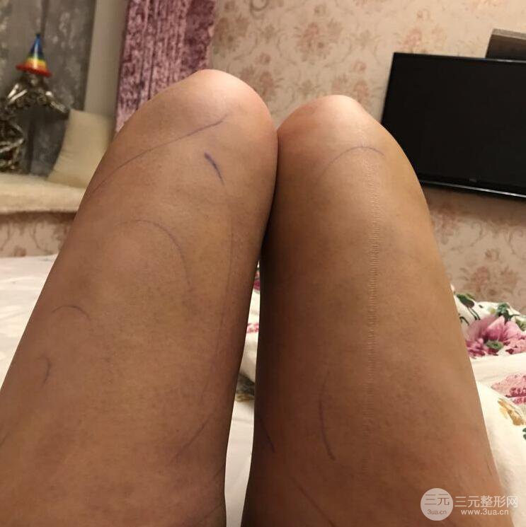 德陽東美奧克拉楊華博大腿吸脂前對(duì)對(duì)比圖 四個(gè)月恢復(fù)變化小記