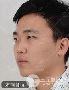 歐陽春雙眼皮前后對比圖 男孩子割雙眼皮一樣好看