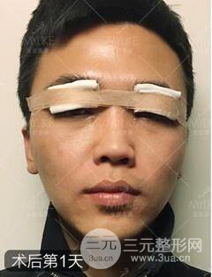 歐陽春雙眼皮前后對比圖 男孩子割雙眼皮一樣好看