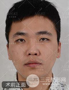 歐陽春雙眼皮前后對比圖 男孩子割雙眼皮一樣好看