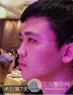 歐陽春雙眼皮前后對比圖 男孩子割雙眼皮一樣好看