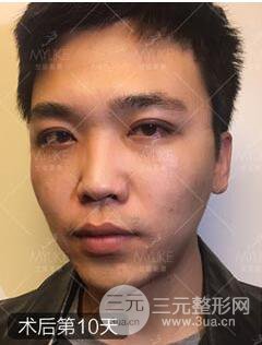 歐陽春雙眼皮前后對比圖 男孩子割雙眼皮一樣好看