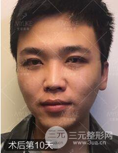 歐陽春雙眼皮前后對比圖 男孩子割雙眼皮一樣好看