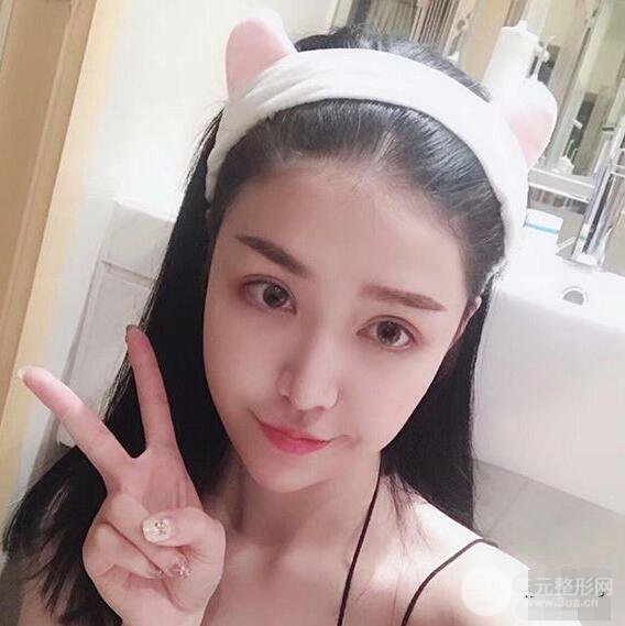 延吉金光善眼部整形失敗修復(fù)前后對(duì)比圖 三個(gè)月恢復(fù)自然