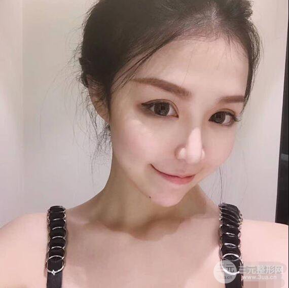 延吉金光善眼部整形失敗修復(fù)前后對(duì)比圖 三個(gè)月恢復(fù)自然