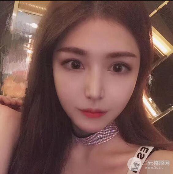 延吉金光善眼部整形失敗修復(fù)前后對(duì)比圖 三個(gè)月恢復(fù)自然