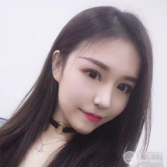 延吉金光善眼部整形失敗修復(fù)前后對(duì)比圖 三個(gè)月恢復(fù)自然