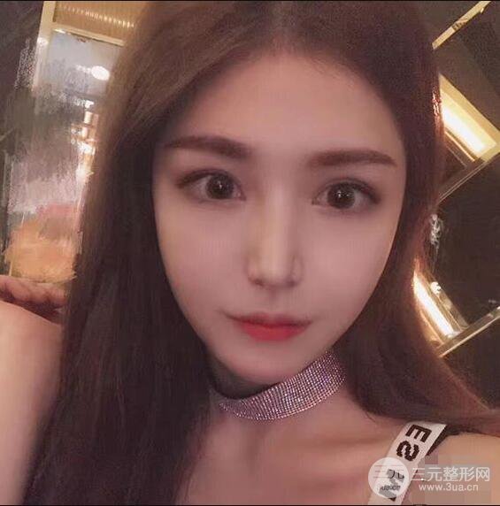 延吉金光善眼部整形失敗修復(fù)前后對(duì)比圖 三個(gè)月恢復(fù)自然