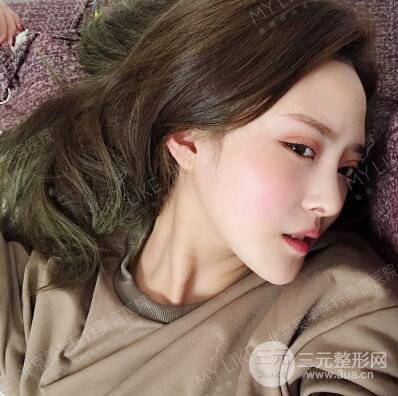 北京美萊趙峻賢隆鼻整形真實案例對比圖恢復過程分享