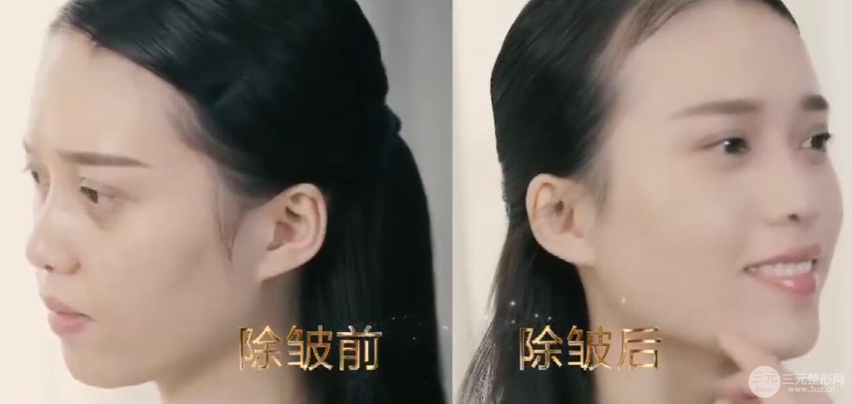 伊w蘭除皺大概需要多少錢呢?