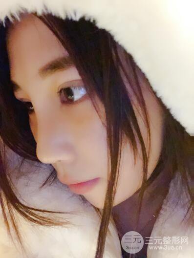 貴陽麗都李觀龍隆鼻整形案例對(duì)照?qǐng)D一個(gè)月恢復(fù)過程分享