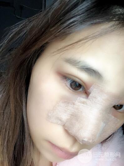 貴陽麗都李觀龍隆鼻整形案例對(duì)照?qǐng)D一個(gè)月恢復(fù)過程分享