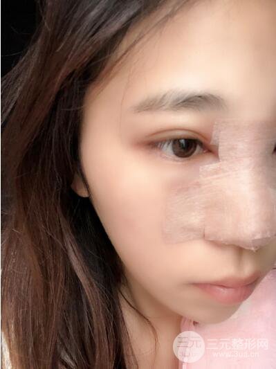 貴陽麗都李觀龍隆鼻整形案例對(duì)照?qǐng)D一個(gè)月恢復(fù)過程分享