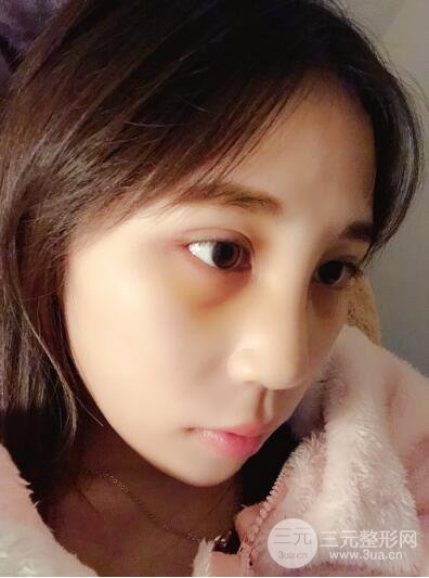 貴陽麗都李觀龍隆鼻整形案例對(duì)照?qǐng)D一個(gè)月恢復(fù)過程分享