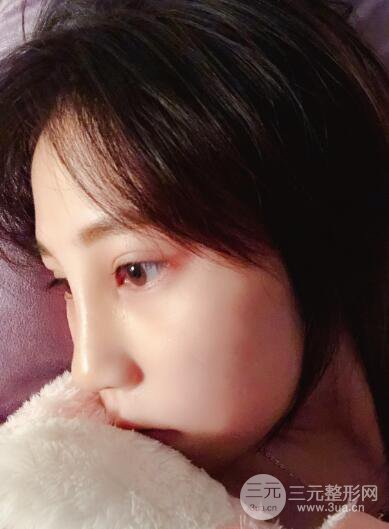 貴陽麗都李觀龍隆鼻整形案例對(duì)照?qǐng)D一個(gè)月恢復(fù)過程分享