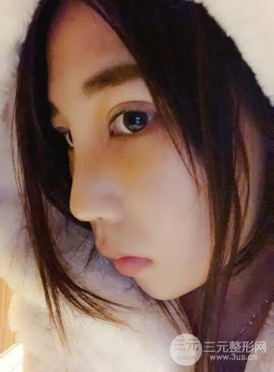 貴陽麗都李觀龍隆鼻整形案例對(duì)照?qǐng)D一個(gè)月恢復(fù)過程分享