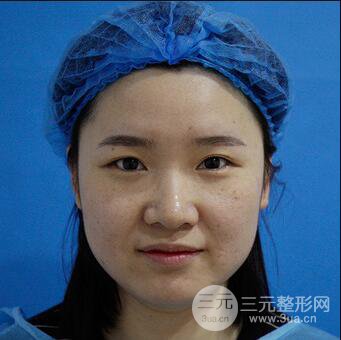 貴陽美萊梁潔芭比媚雙眼皮多項整形前后對比圖恢復心情小札