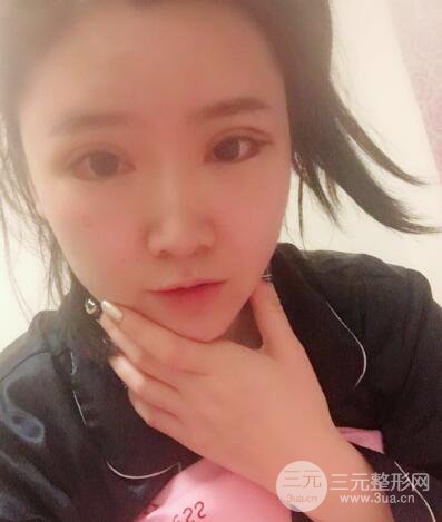 貴陽美萊梁潔芭比媚雙眼皮多項整形前后對比圖恢復心情小札
