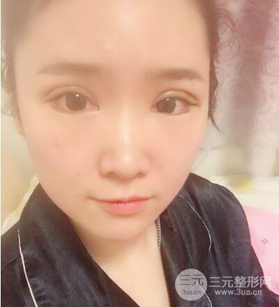 貴陽美萊梁潔芭比媚雙眼皮多項整形前后對比圖恢復心情小札