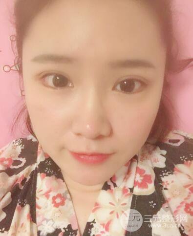 貴陽美萊梁潔芭比媚雙眼皮多項整形前后對比圖恢復心情小札