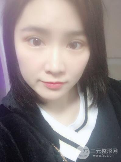 貴陽美萊梁潔芭比媚雙眼皮多項整形前后對比圖恢復心情小札