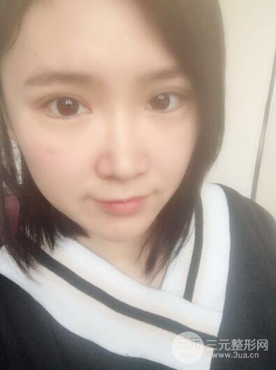 貴陽美萊梁潔芭比媚雙眼皮多項整形前后對比圖恢復心情小札
