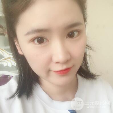 貴陽美萊梁潔芭比媚雙眼皮多項整形前后對比圖恢復心情小札
