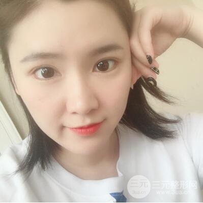 貴陽美萊梁潔芭比媚雙眼皮多項整形前后對比圖恢復心情小札