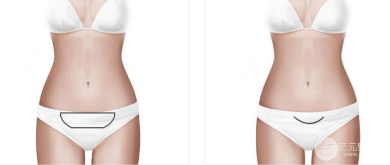 360度吸脂減肥多久恢復(fù)