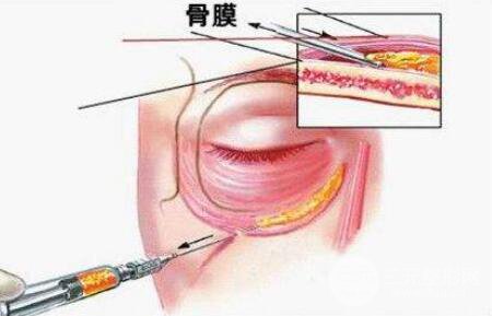 玻尿酸填充淚溝風險
