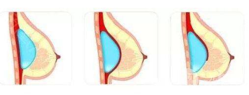 蜜桃假體隆胸多少錢