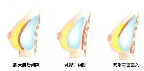 隆胸之后可以坐飛機(jī)嗎？