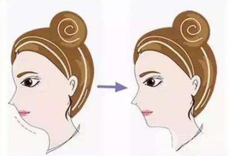 玻尿酸墊下巴價(jià)格多少錢？果好不好？