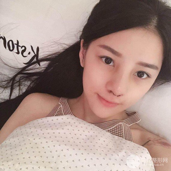 【隆鼻整形+進口假體+耳軟骨墊鼻尖+鼻頭鼻翼縮小+鼻尖延長】綜合改良！