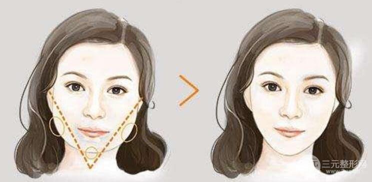 下頜角切除費用要多少？怎么護理？