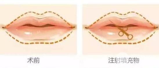玻尿酸豐唇整形手術(shù)要多少錢？?jī)r(jià)格影響在于？