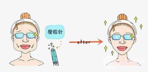 注射注射瘦臉瘦臉的副作用嚴(yán)重嗎？需要注意什么
