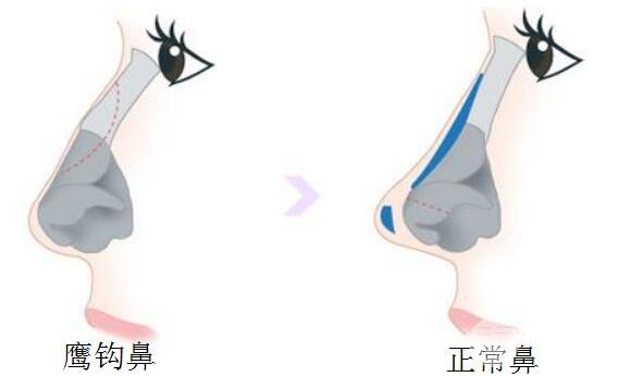 鷹鉤鼻矯正方法有什么？手術(shù)過(guò)程是怎樣的？