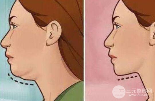成都雙下巴吸脂價(jià)格多少?費(fèi)用貴嗎?