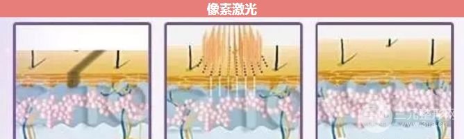 像素激光