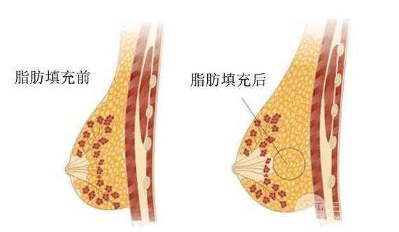自體細胞豐胸