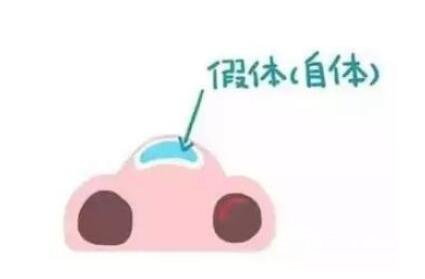 骨膜下隆鼻整形手術(shù)怎么做的？哪種情況適合做？