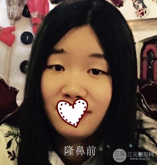 硅膠隆鼻要多少錢