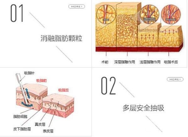抽脂減肥手術(shù)怎么做