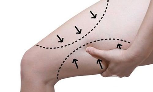 大腿內(nèi)側(cè)吸脂多少錢 多久恢復(fù)自然
