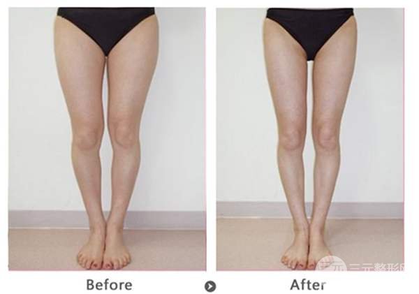 大腿內(nèi)側(cè)吸脂多少錢 多久恢復(fù)自然